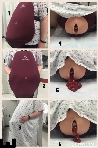 Photo collage. 1: Standardized Participant (SP) wearing birthing simulator. 2: SP adjusting simulator. 3: SP wearing gown. 4: simulated labia with gown draping. 5: cup of cherry pie filling hemorrhaging from labia. 6: tablespoon of filling hemorrhaging.