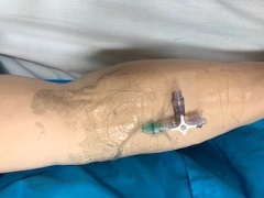 manikin arm with extensive adhesive residue and an external IV circuit affixed on antecubital fossa