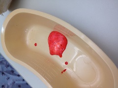 red foam in kidney shaped emesis basin
