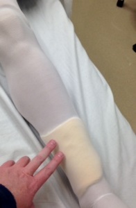 hand touching swollen lower calf of a manikin wearing an anti-embolism stocking